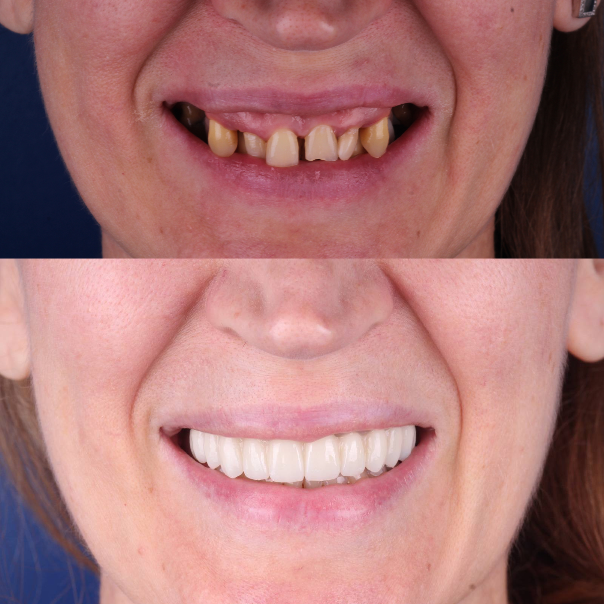 Комплексное восстановление улыбки — клиническая история Premium Smile
