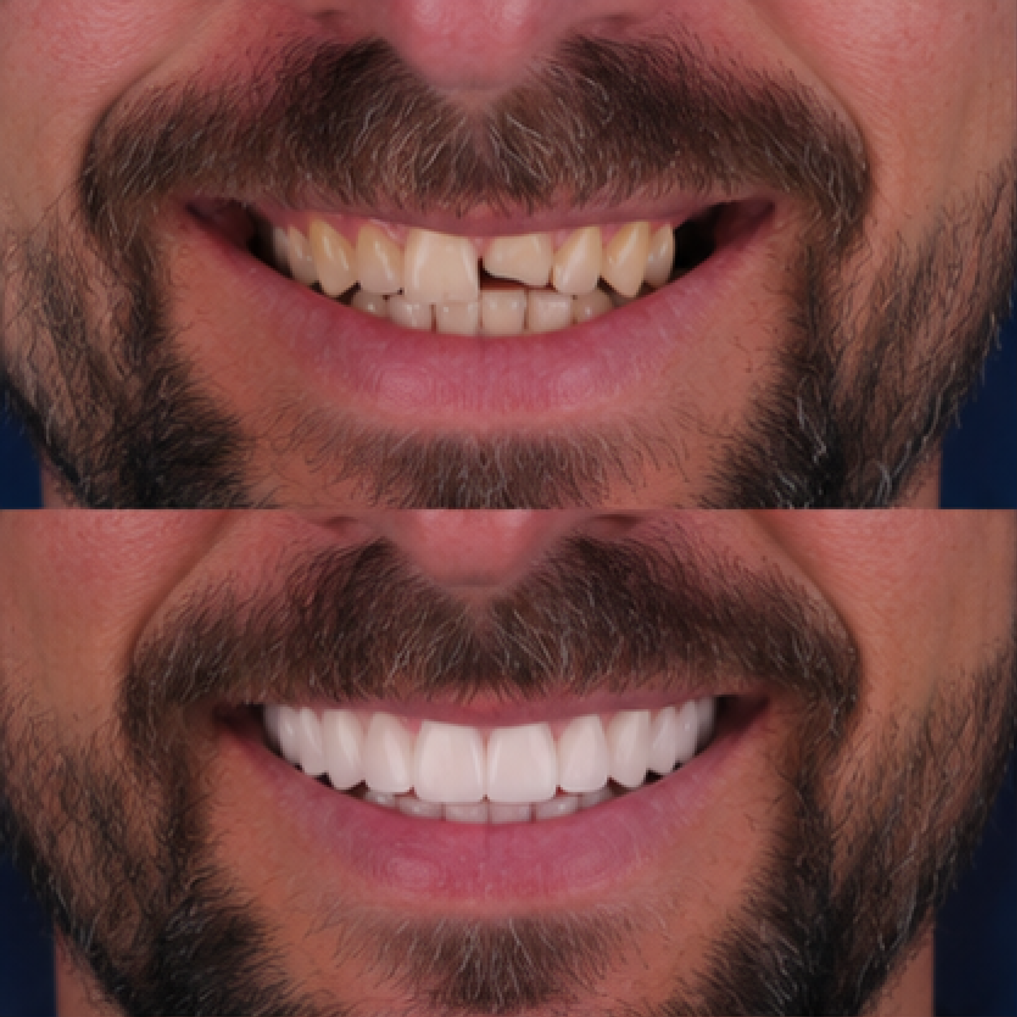 Работа с линией улыбки — клиническая история Premium Smile