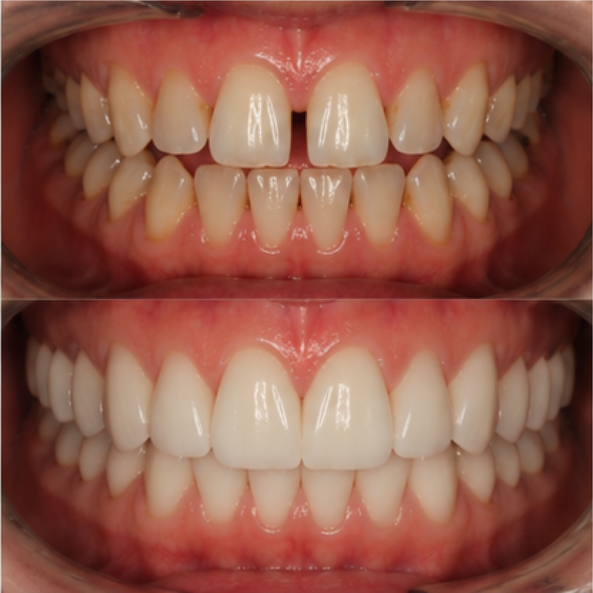 Восстановление зубного ряда — клиническая история Premium Smile