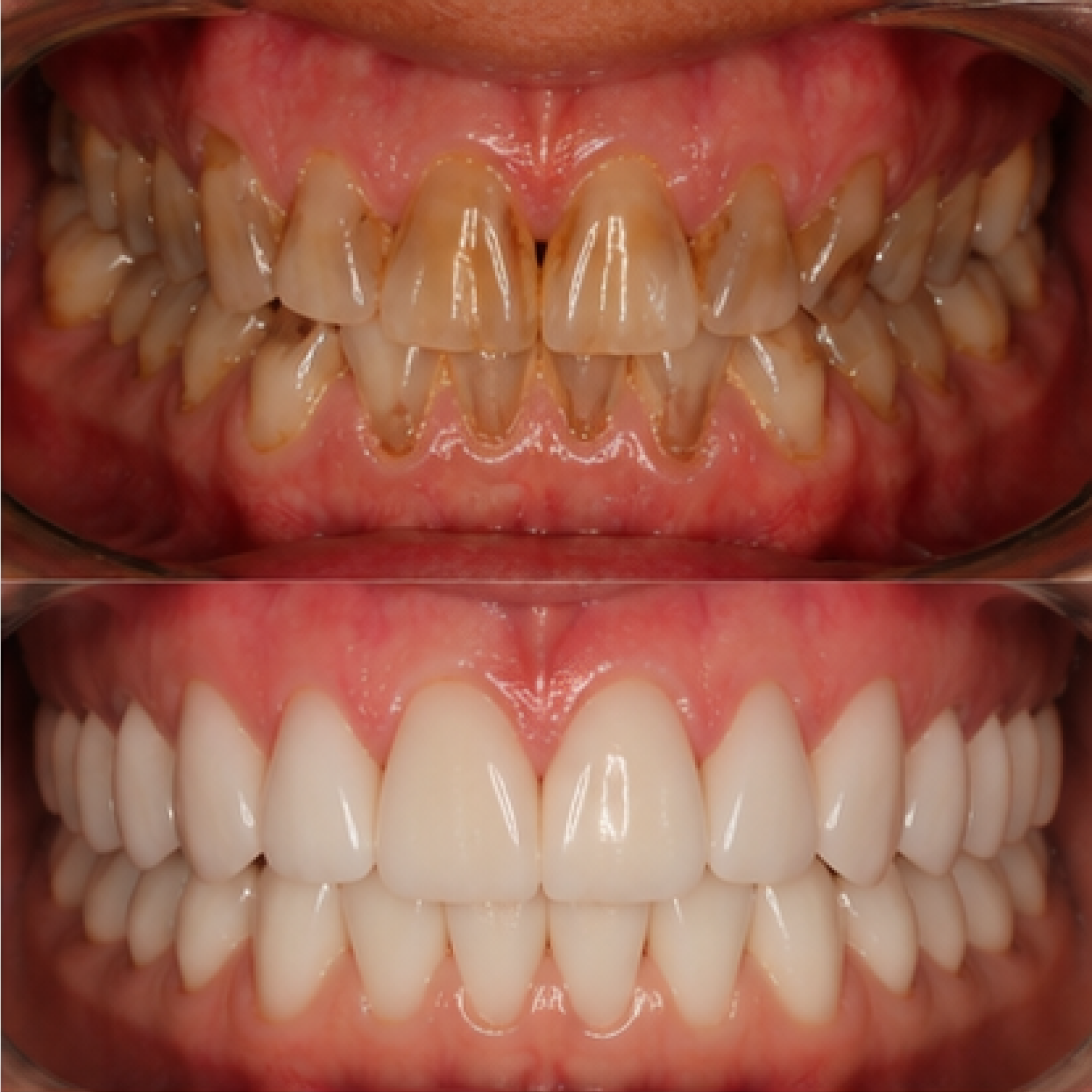 Финальная эстетика улыбки — клиническая история Premium Smile